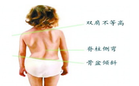 脊柱侧弯